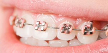 Ortodontie pentru copii Timisoara